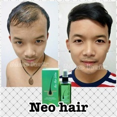 นีโอแฮร์ แท้ 100% neo hair lotion สมุนไพร ช่วยบำรุ