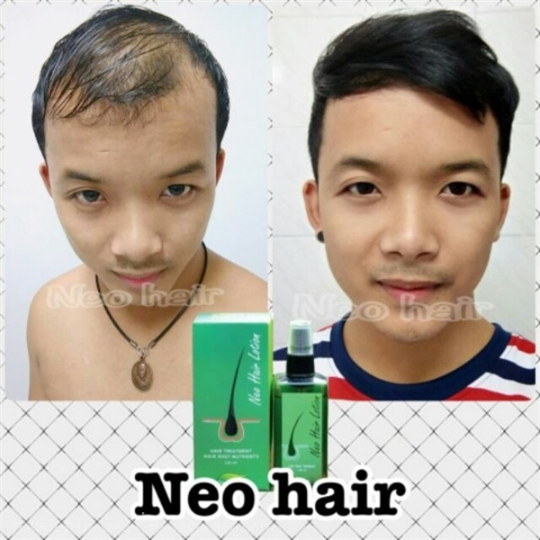 นีโอแฮร์ แท้ 100% neo hair lotion สมุนไพร ช่วยบำรุ | Shopping by lewat - เมืองมหาสารคาม มหาสารคาม